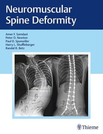 Neuromuscular Spine Deformity.jpg