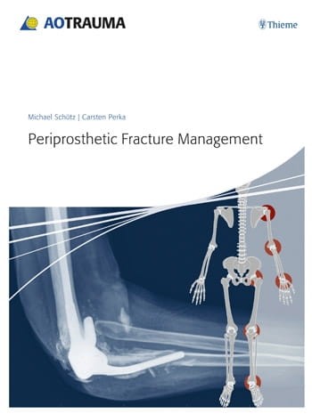 Periprosthetic Fracture Management.jpg